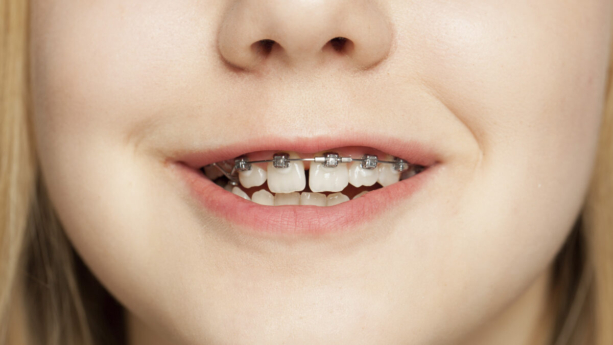 bg-entrada-braquets